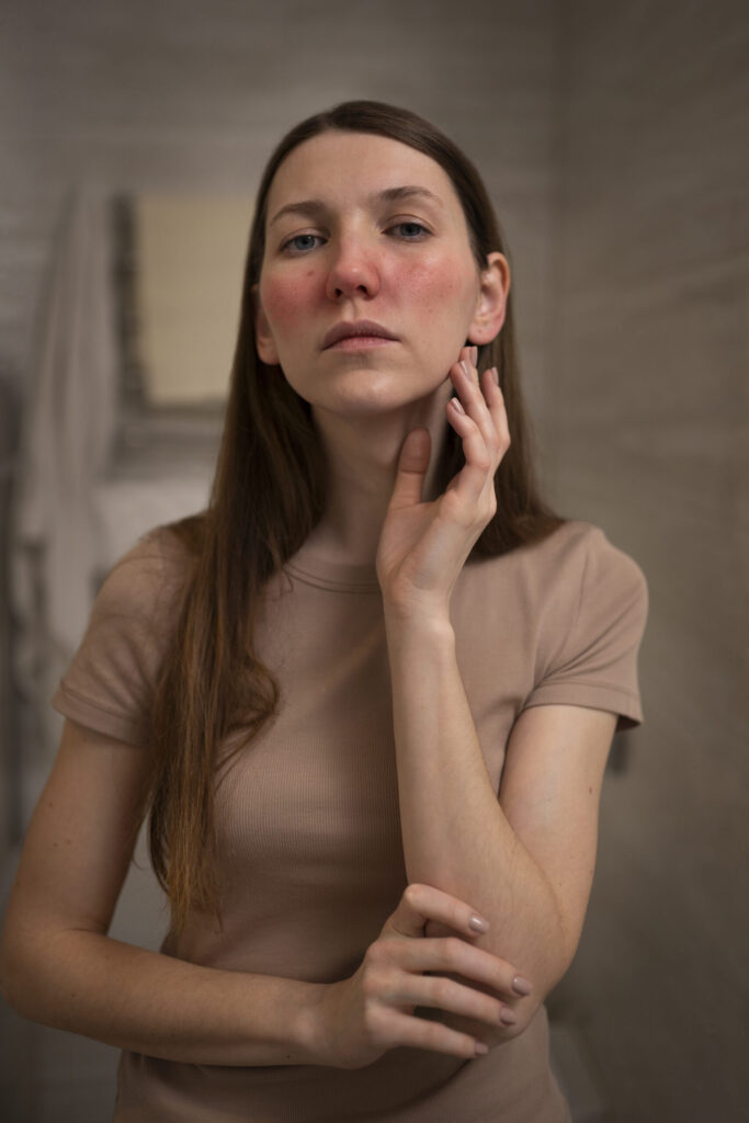 woman-dealing-with-rosacea-skin-condition-face-scaled